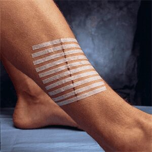 Wound Closure Products Market Growth Drivers, Segment Analysis and Future Growth