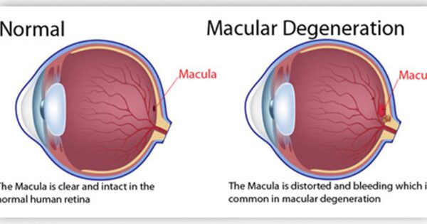 Wet Age-Related Macular Degeneration (AMD) Market Worldwide Industry Analysis