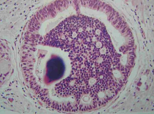 Медики из НГУ совершенствуют методы диагностики рака молочной железы Медики из НГУ совершенствуют методы диагностики рака молочной железы