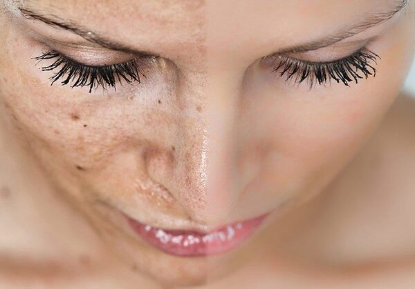 Устали от гиперпигментации кожи? У нас есть решение! Устали от гиперпигментации кожи? У нас есть решение!