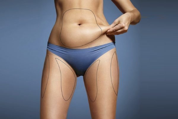 Владимир Плахотин: липосакция бёдер Владимир Плахотин: липосакция бёдер