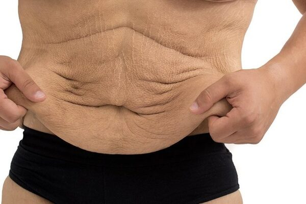 Александр Вдовин: что делать с излишками кожи после похудения Александр Вдовин: что делать с излишками кожи после похудения