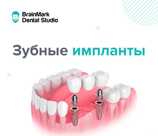 Акция на установку зубных имплантов в клиниках BrainMark Dental Studio Акция на установку зубных имплантов в клиниках BrainMark Dental Studio