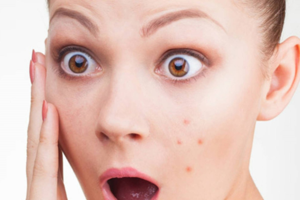 Владимир Ивкин рассказал, какие причины стоят за появлением прыщей Владимир Ивкин рассказал, какие причины стоят за появлением прыщей